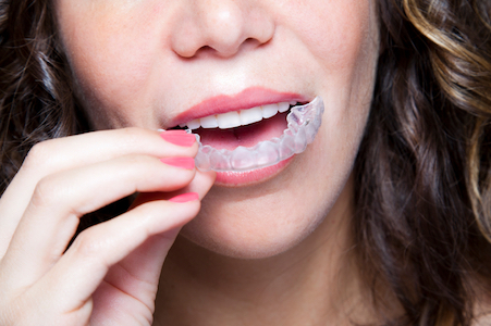 Invisalign may be just what you need to discreetly get your straight teeth back using invisible braces!