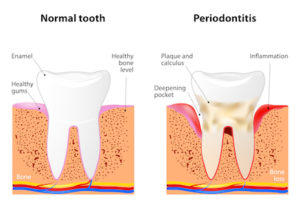Image showing how gum disease and periodontitis can cause more decay on a tooth.