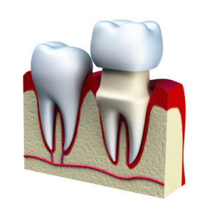 Image showing how a dental crown fits over a tooth. 