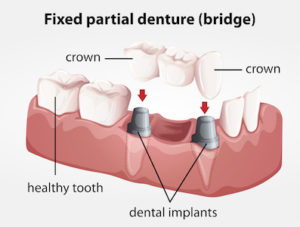 Surrey General Dentistry Dental Bridge