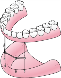 all on four dental implants