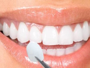 Cosmetic Dentist Surrey Dental Veneers