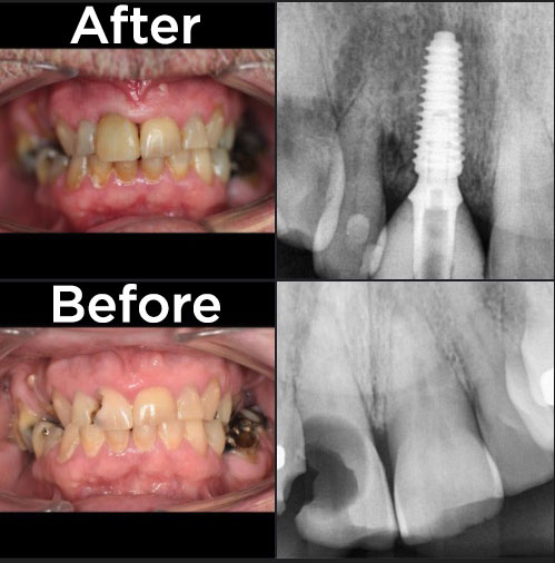 case study of dental implant case in Surrey