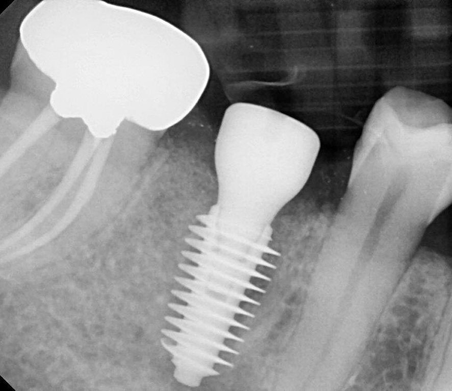 case study of dental implant case in Surrey