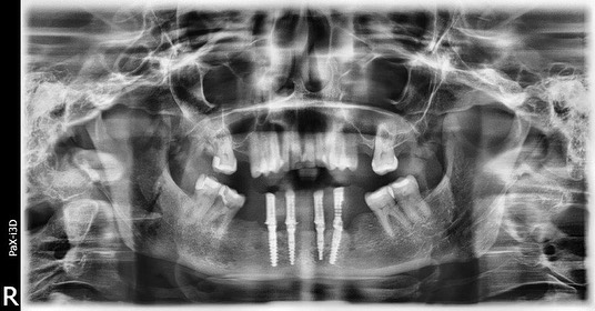 case study of dental implant case in Surrey