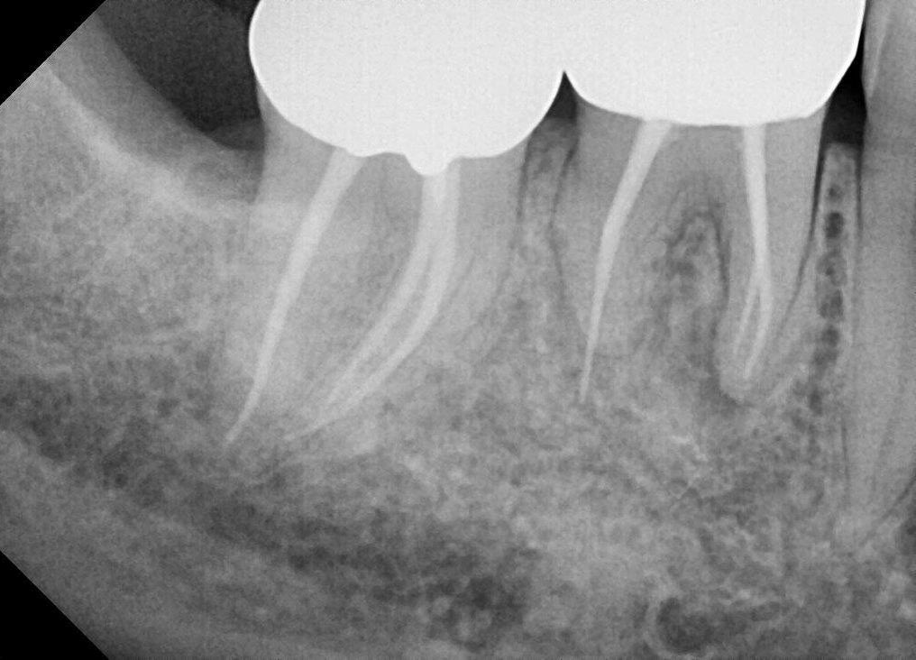 case study of dental implant case in Surrey