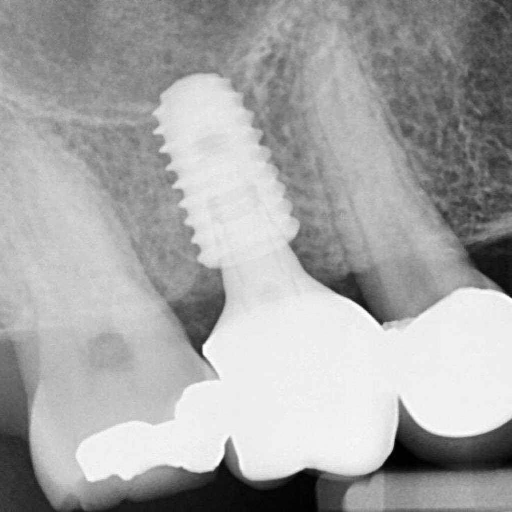Dental Implant Case Study