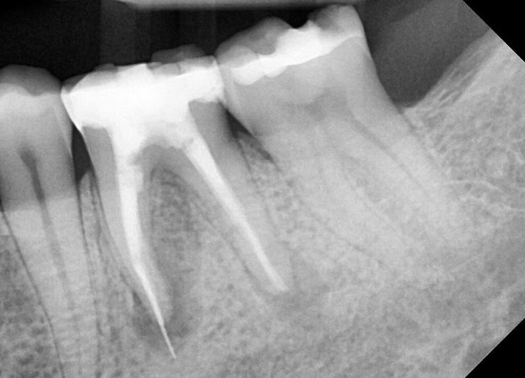 case study of dental implants